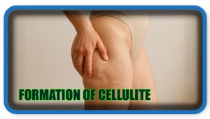 Formation of Cellulite
