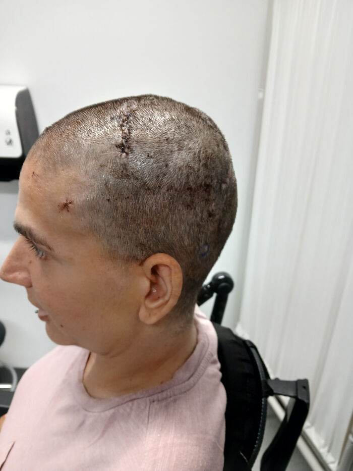 Neuralink Woman’s Mind-Control Shocks the World