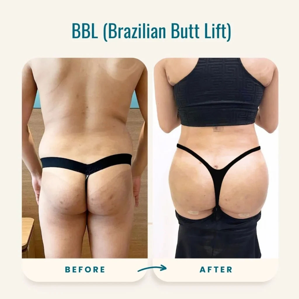 Mum Dies After Butt-Lift