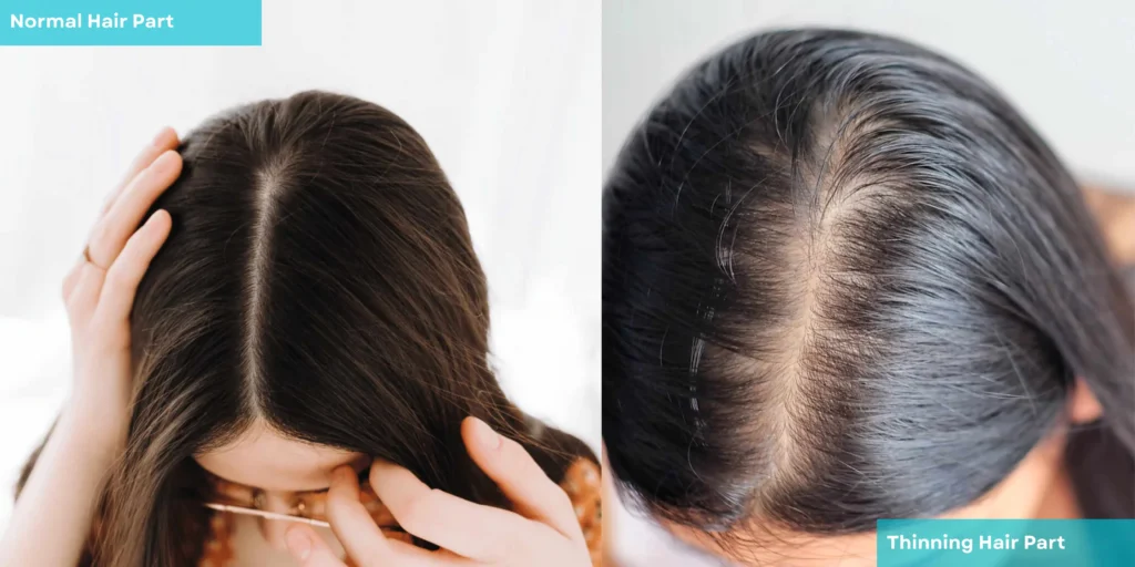 Mistake People Make When They Notice Their Hair Is Thinning