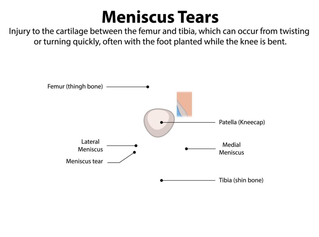 ACL and Meniscus Tear